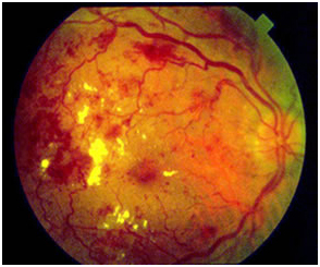 diabetic retinopathy - eyes