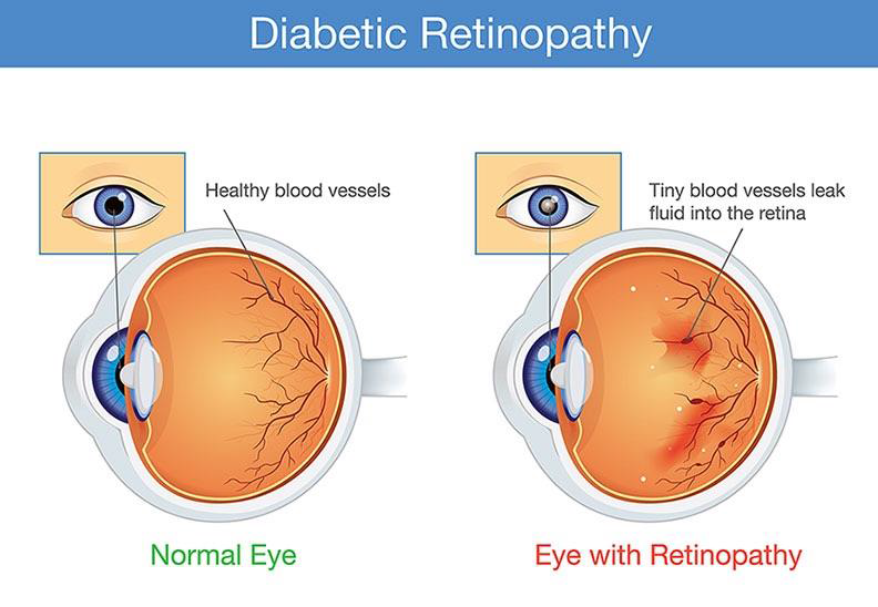 Healthy eye (left) compared to an eye with diabetic retinopathy (right)
